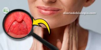 Dor na garganta: Como saber se a garganta está inflamada?