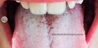 Dentista ensina como terminar com mau hálito causado pela saburra