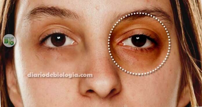 Como acabar com olheiras: Aprenda como clarear olheiras