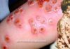 Virose rara: varíola bovina em humanos está de volta depois de 40 anos
