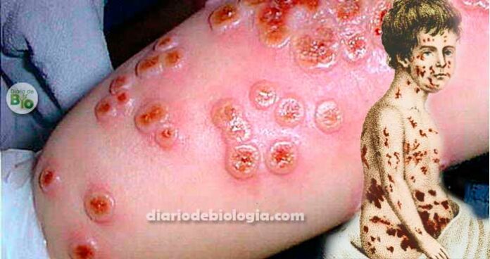 Virose rara: varíola bovina em humanos está de volta depois de 40 anos