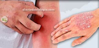 Manchas vermelhas na pele: vejas as causas mais comuns