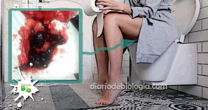 É normal sair coágulos de sangue na menstruação?