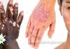 doenças de pele mão e rosto