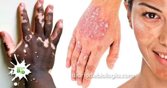 doenças de pele mão e rosto