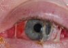 Causas comuns da inflamação no olho
